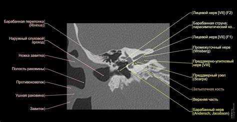 Сравнение методов КТ и МРТ в оценке височной кости