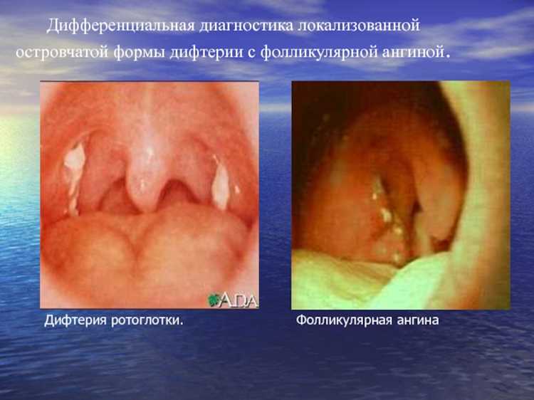 Профилактика ангины: что может помочь