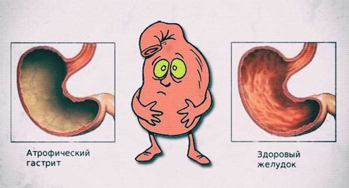 Опыт других пациентов: успешные истории борьбы с проблемами желудка