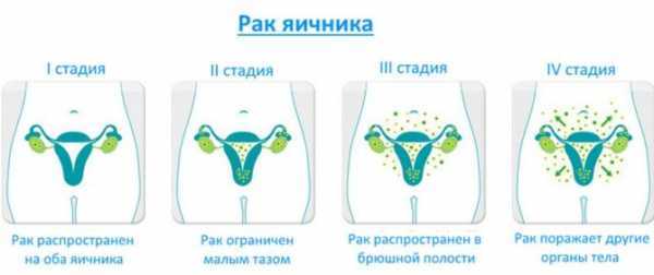 Биопсия яичников: показания и противопоказания