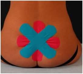 Кинезиотейпирование