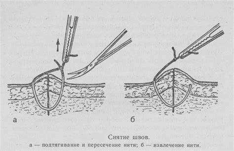 Разница во времени рассасывания внутренних и наружных швов